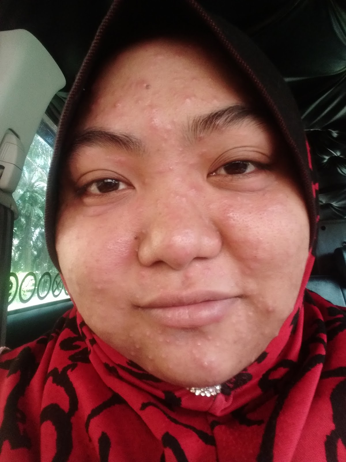 Memahami Mimpi Kena Cacar: Arti, Psikologi, dan Cara Menanggapinya