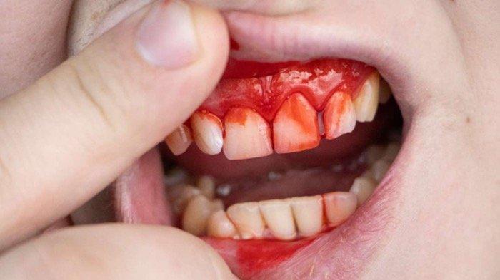 Mengungkap Makna Tersembunyi di Balik Mimpi Gusi Berdarah